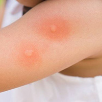 INSECT BITES